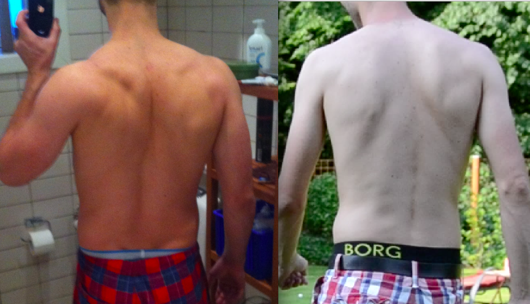 Andreas før og efter - ryg
